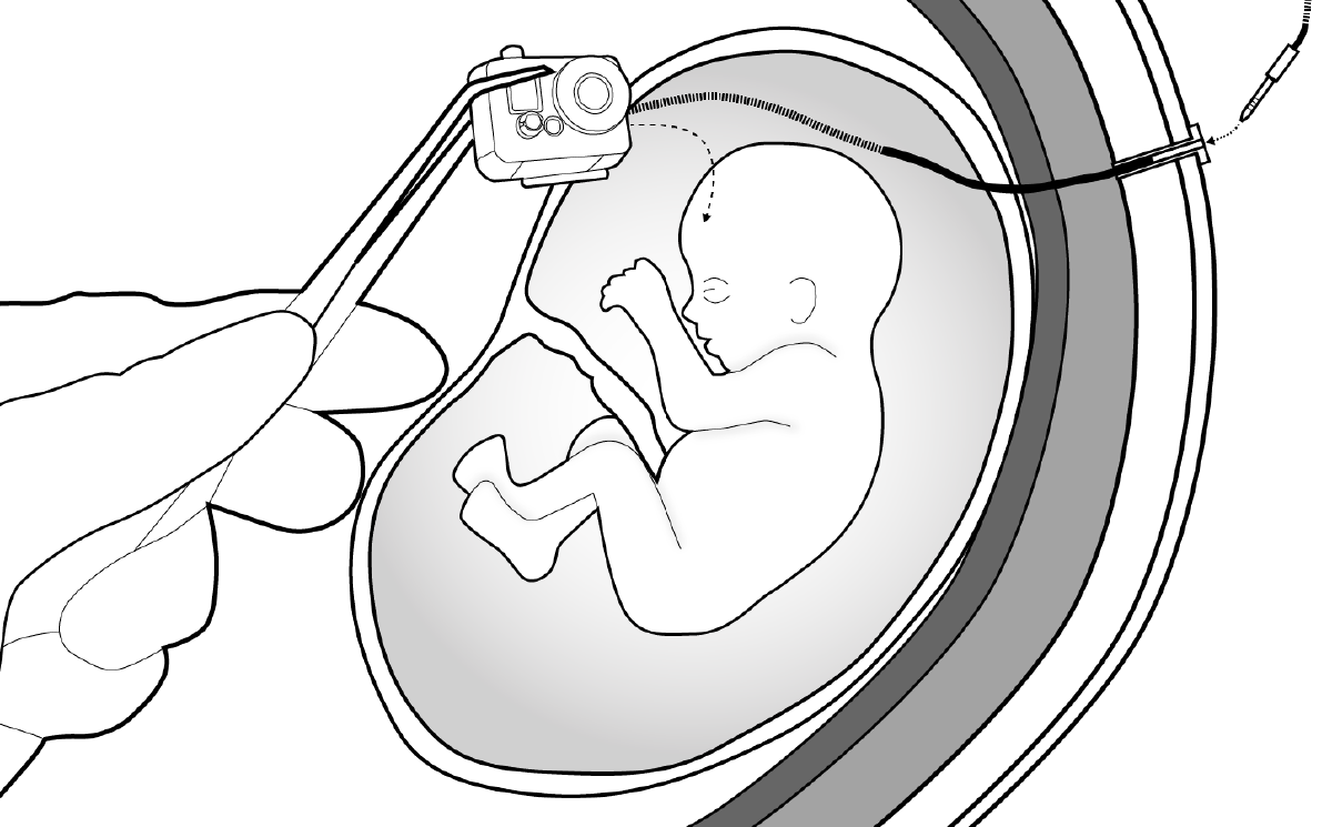 Figure 2: Two miniaturized GoPro cameras are affixed to the skull of the fetus.